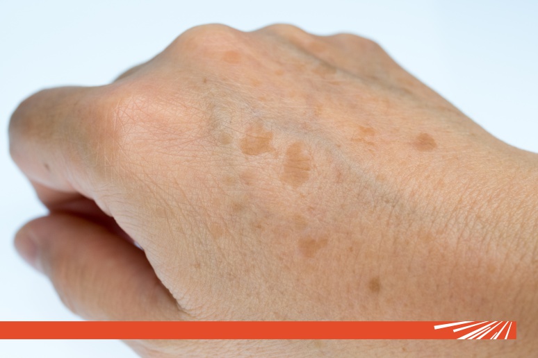 Petele hiperpigmentare: pot fi sau nu tratate?