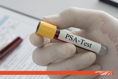 Testul PSA: când este recomandat?
