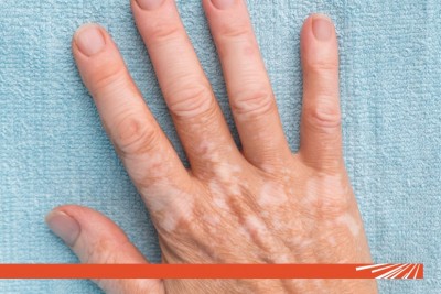 Pete albe pe piele – ce pot ascunde și când este recomandat consultul dermatologic?